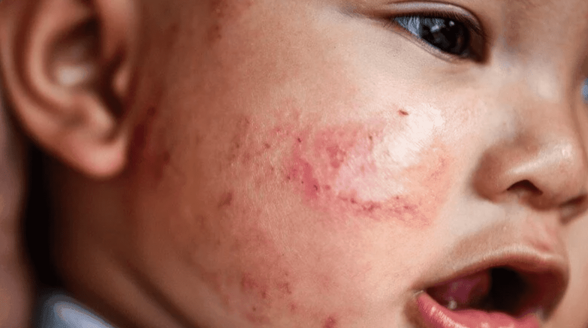 Close-up of a child's cheek with a red, irritated skin rash.