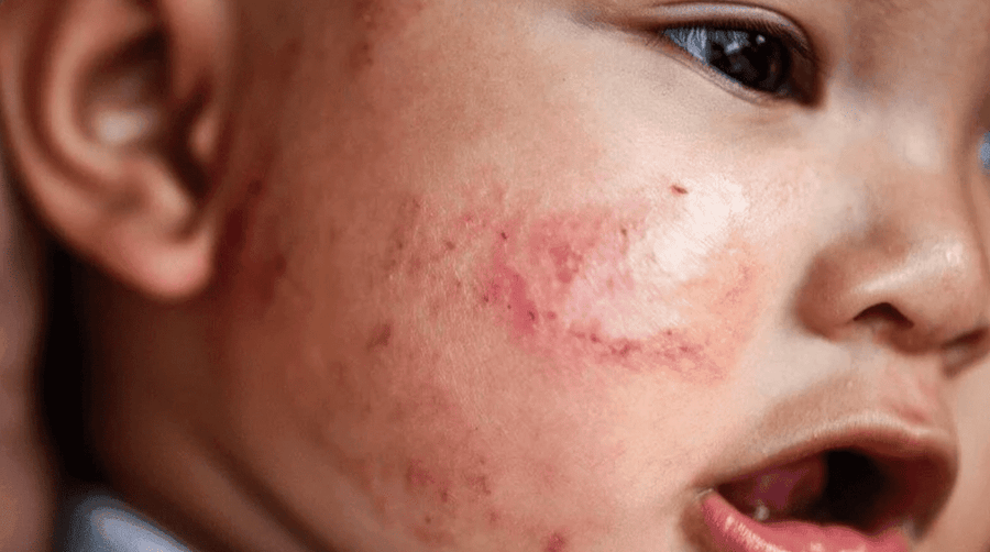 Close-up of a child's cheek with a red, irritated skin rash.