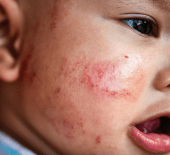Close-up of a child's cheek with a red, irritated skin rash.
